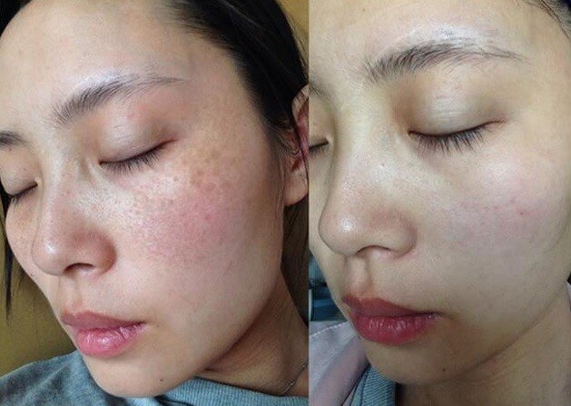 Làn da thay đổi sau khi sử dụng Ketoskin