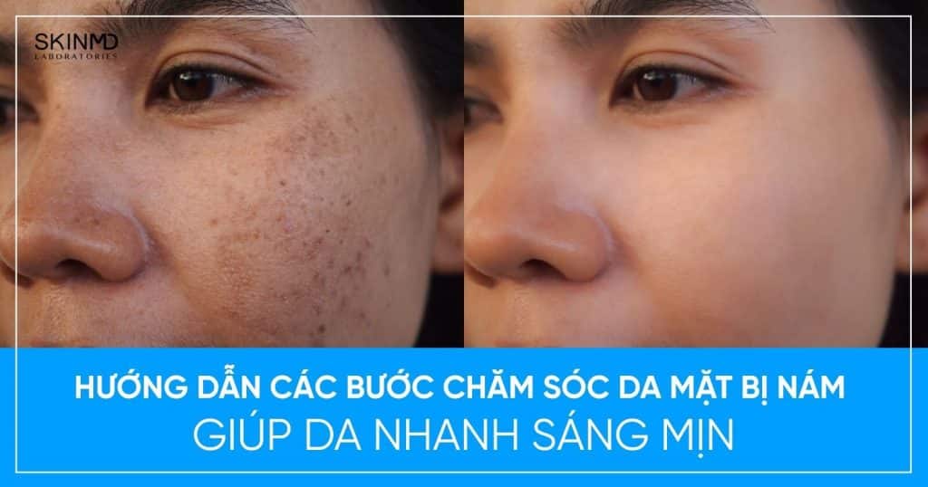 Các bước chăm sóc da mặt bị nám