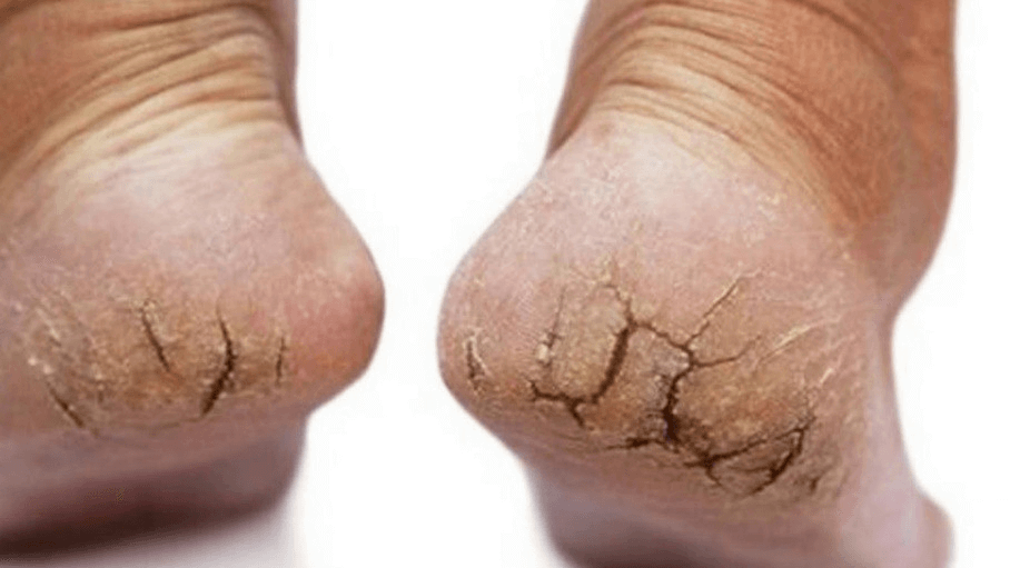 Bệnh nứt gót khiến đôi bàn chân bị mất thẩm mỹ